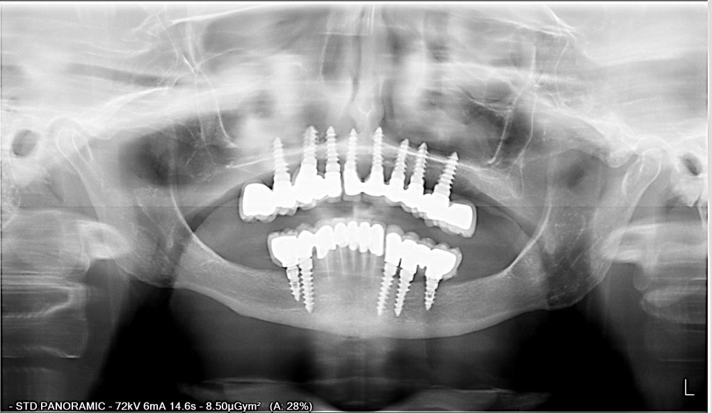 Couronne dentaire ou prothèse sur implants: que choisir? - Dentisterie Hanok